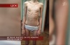 анореския девочка в трусах